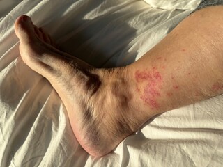 Vasculitis blood vessel inflammation on the lower leg above the ankle