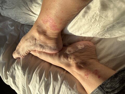 Vasculitis blood vessel inflammation on the lower leg above the ankle