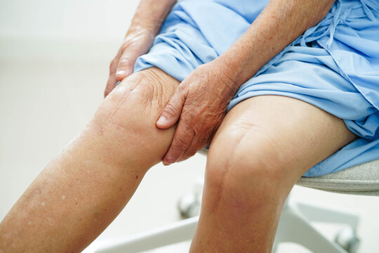 Asian elderly woman patient with scar knee replacement surgery in hospital.