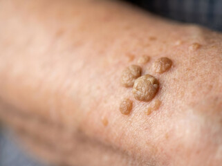 Cancer health concept care background woman doctor skin mole closeup medical examination dermatology aging arm patient diagnosis clinic growth treatment prevention Cancer check concept