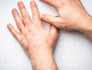 A closeup of a dermatological problem rash on a hand-gilbert's pityriasis closeup.