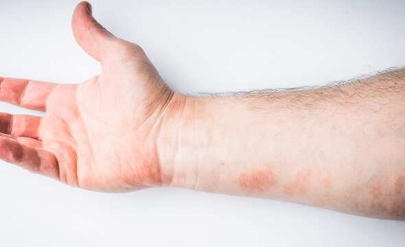 A closeup of a dermatological problem rash on a hand-gilbert's pityriasis closeup.