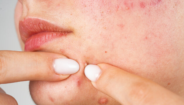 Acne squeezing on facial skin in macro. Pimple extraction on cheek. Acne dermatology concept. Pimple problem on face in closeup. Acne squeezing. Presses acne and pimples on skin with fingers.