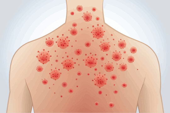 Illustration of Shingles Rash on Human Skin