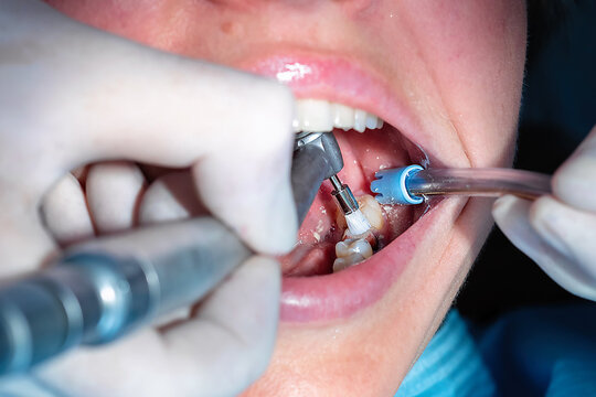 Dentist applying bonding agent to prepared tooth before dental crown cementation. Prosthodontic procedure using dental instruments in a modern, sterile dental clinic.