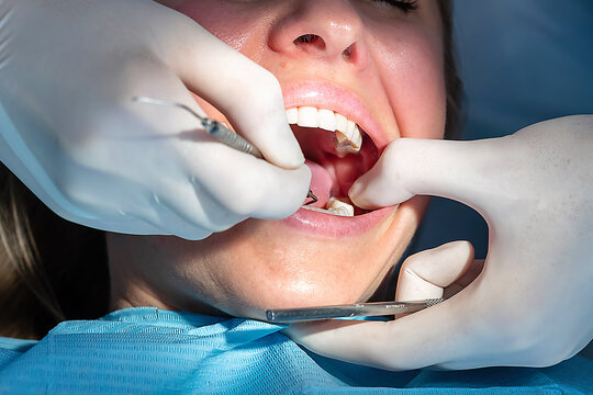 Dentist performing dental crown fitting to check shape and alignment before final cementation. Prosthodontic procedure in a modern dental clinic with sterile conditions.