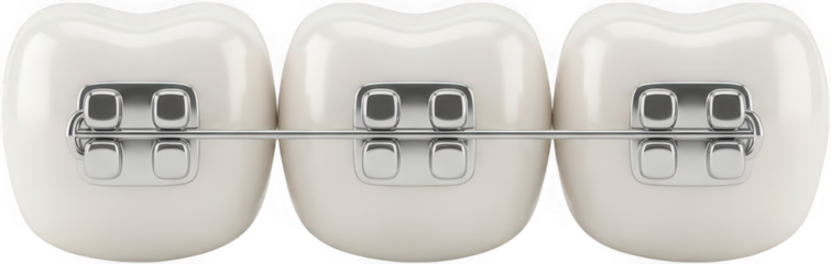 Close up of three white teeth with metallic dental braces and a silver wire straightening them for orthodontic treatment orthodontics metal braces dental care dental hygiene transparent background