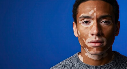 Portrait of a Man with Vitiligo Against Blue Background