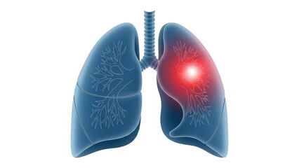 Medical illustration of human lungs showing inflammation or infection in the right organ