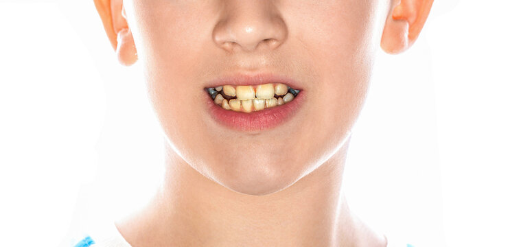 Dentistry closeup. Bad teeth child. Mouth of a man with crooked yellow teeth close-up. Dental problem. Yellow teeth of a woman before treatment and whitening of teeth, dental crowns