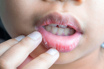 Close-up of dry, chapped human lips with visible peeling skin, showing dehydration and lip care problem. Skincare, dermatology, beauty and health concept with natural skin texture and detail Face