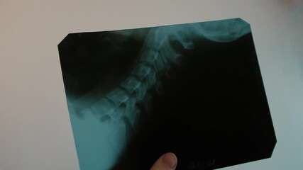 Close-up of doctor examining patient neck backbone x-ray film scan at radiology department in hospital standing by light board, thinking about diagnosis. Shooting in slow motion.  - Powered by Adobe