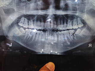 A photo of teeth X-Ray. Selective focus. 