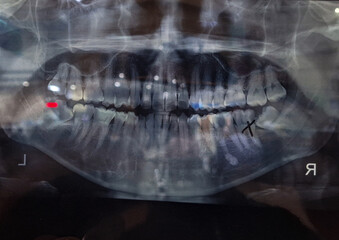 A photo of teeth X-Ray. Selective focus. 