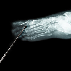 Metal pointer in front of X-ray of the front foot after Hallux Valgus surgery black background