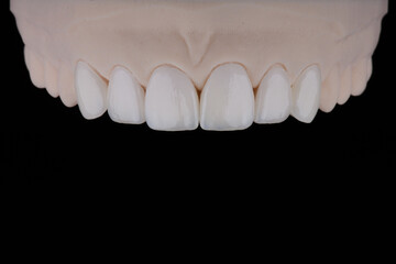 High-quality six dental crowns made of zirconium for fixation to the frontal teeth of upper jaw. © gorynvd