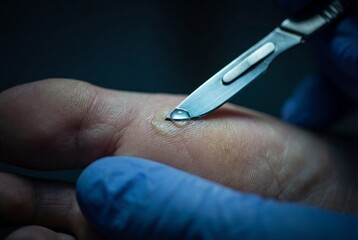 Medical specialist treating foot callus with sharp scalpel blade and liquid drop close up