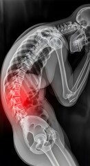 X-ray of Kyphosis - Spinal Curvature and Posture Analysis.