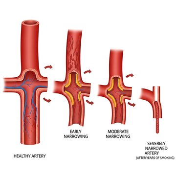 Artery Health Progression - Healthy to Severely Narrowed, Smoking Impact.