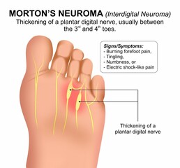 Morton&rsquo;s Neuroma Foot Medical Flashcard