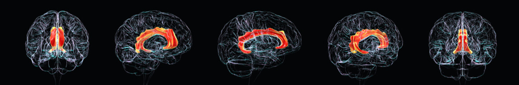 Cingulate gyrus, 3D illustration showing the human brain in multiple anatomical views with the cingulate gyrus highlighted to demonstrate its position in the medial cerebral cortex.