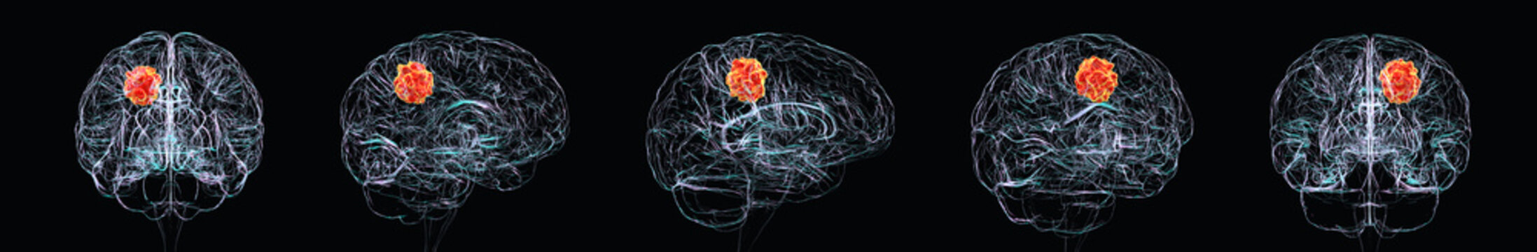 Brain tumour, 3D illustration showing multiple views of the human brain with an abnormal mass highlighted to demonstrate tumour localisation within cerebral tissue.