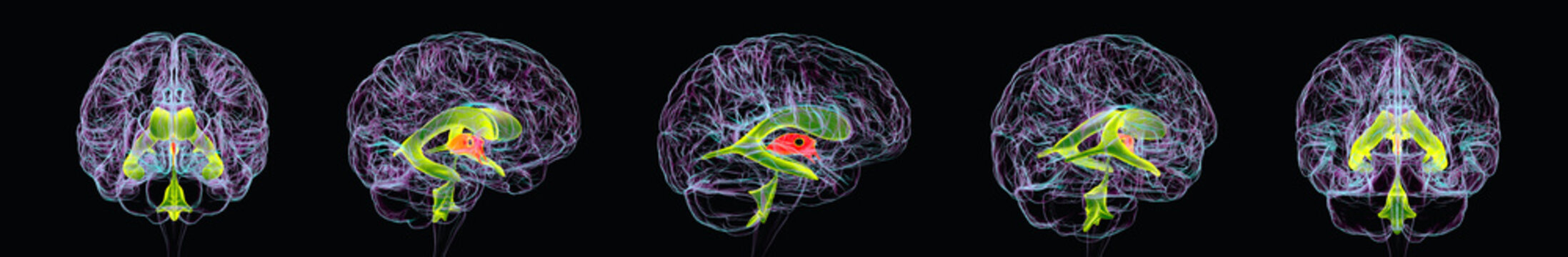 Third ventricle, 3D illustration showing the human brain with the third ventricle highlighted in multiple anatomical views within the diencephalon.
