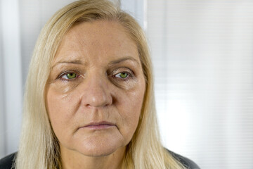Wrinkled Mature woman before face lift surgery.