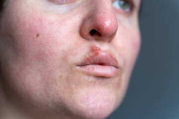 Fototapeta premium Low Angle Close Up of Herpes on Lip and Nose with Inflamed Skin