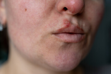 Obraz premium Side View of Female Face with Active Herpes Infection on Lip and Nose