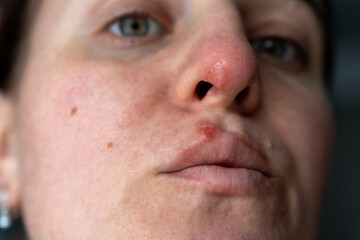 Fototapeta premium Close Up of Woman with Herpes on Lip and Nose Showing Natural Skin Texture