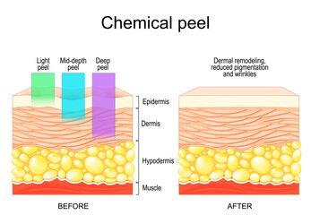 Chemical peeling. Human skin Before and after exfoliation. Dermatological procedure. Wrinkle reduction. 