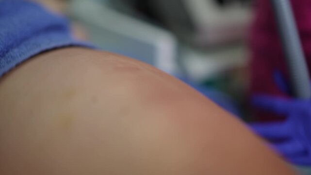 Shoulder ultrasound therapy in clinic, closeup shows medical practitioner wearing purple gloves applying handheld ultrasound device to patients bare shoulder