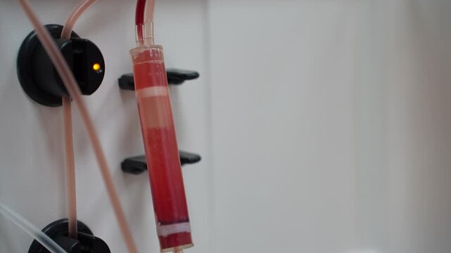 Blood donation. A close-up of blood being delivered to a patient from an apheresis machine during a medical donation procedure.