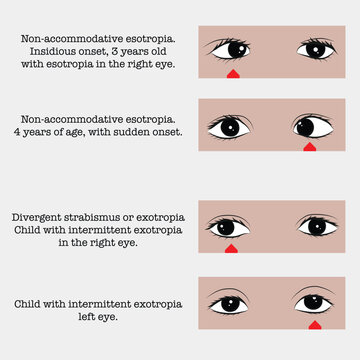 Accommodative esotropia and persistent strabismus: eye diseases in children.