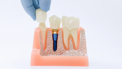Gloved hand positioning crown on dental implant model