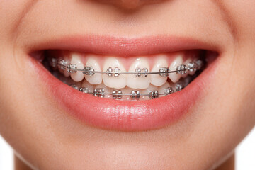 Obraz premium Person shows teeth with braces during a dental checkup in a clinic setting in the afternoon