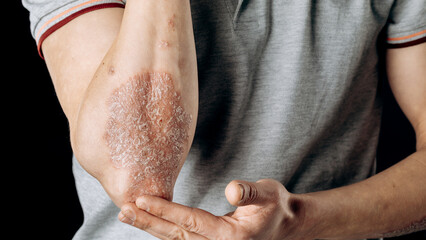 The use of an emollient on dry, flaky skin, as in the treatment of psoriasis, eczema and other dry skin