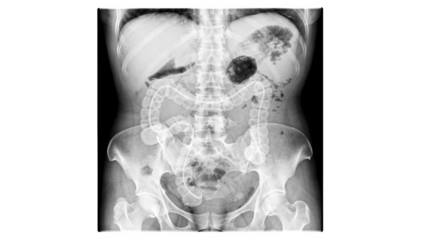 Abdominal Xray image showcasing prominent airfluid levels indicative of bowel obstruction isolated on white background with clear radiologystyle emphasis on internal
