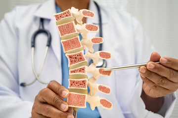 Doctor holding osteoporosis in back bone model for treatment medical in orthopedic department.
