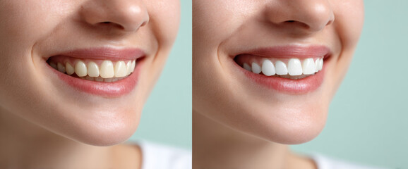 Close-up comparison of a woman's smile before and after teeth whitening treatment showing improved dental brightness and health