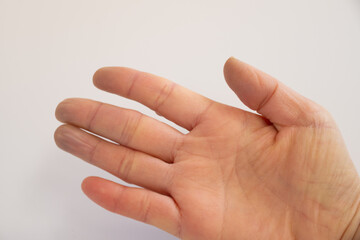 チアノーゼの症状が出ている手の指先