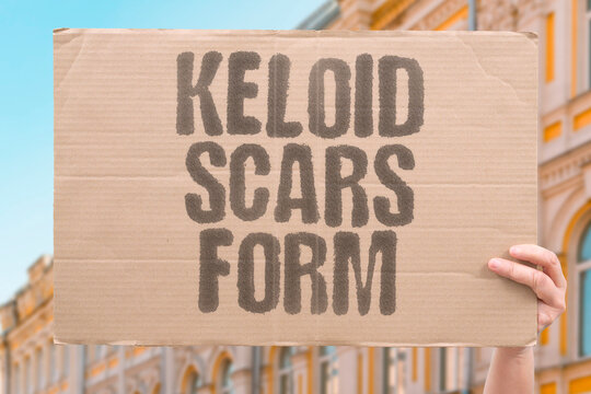 "Keloid Scars Form" Raised tissue develops abnormally. KELOID. SCARS. RAISED. TISSUE. ABNORMAL.