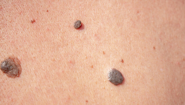 Nevus close-up. Mole on human skin. Irregular birthmark.