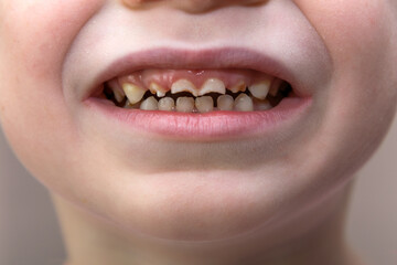 Children's teeth with hypoplasia, dental decay