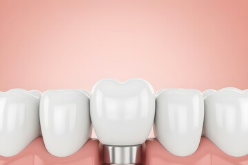 Dental implant with crown in gum, 3D render illustration of teeth restoration, professional stomatology concept background.