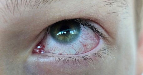 Closeup irritated infected red bloodshot eyes, conjunctivitis concept