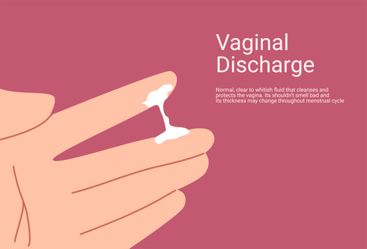 Vaginal discharge symptoms, medical concept of yeast infection, bacterial vaginosis and female reproductive health. Abnormal discharge vector illustration