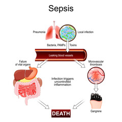 Sepsis. Dangers of blood infection. Cytokine storm. Pneumonia