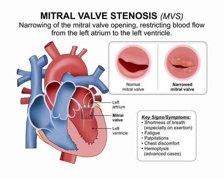 Mitral Valve Stenosis (MVS) Medical Flashcard